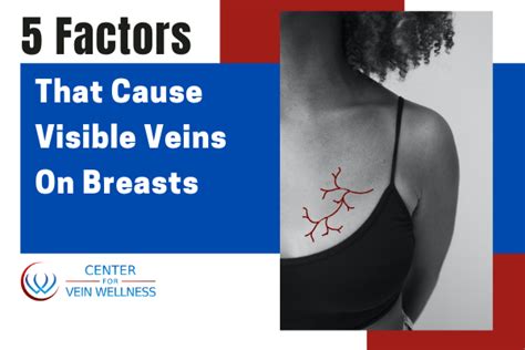 big veiny breasts|Understanding and Treating Visible Veins in the Breast and Chest.